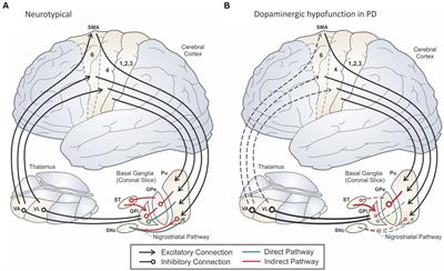 A neurocomputational view of the effects of Parkinson’s disease on speech production